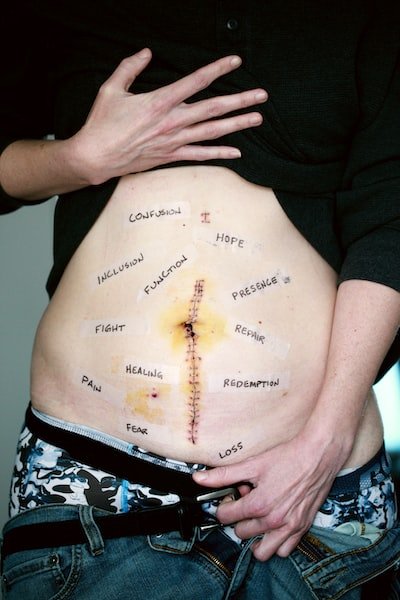 L’abdominoplastie : une solution pour obtenir un ventre plat
